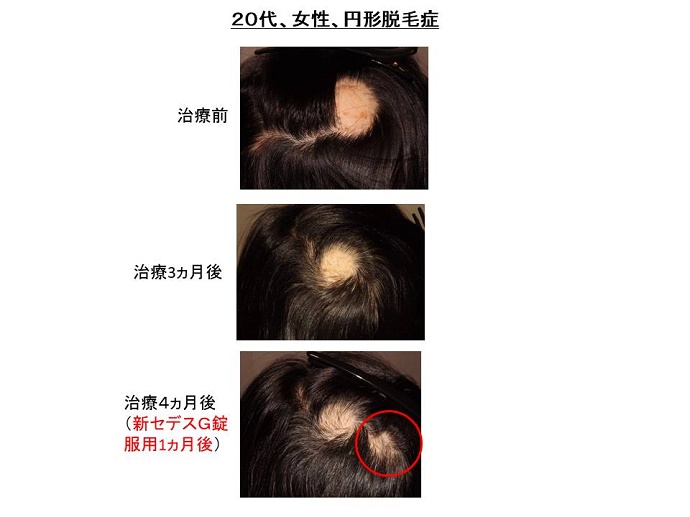 円形脱毛症　病院"